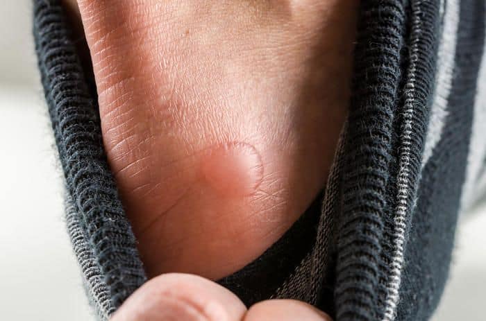 vesciche ai piedi